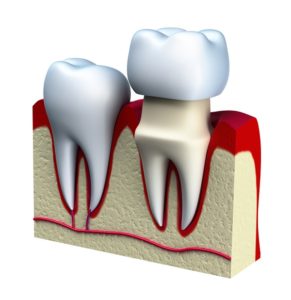 Illustration of Dental Crown Procedure