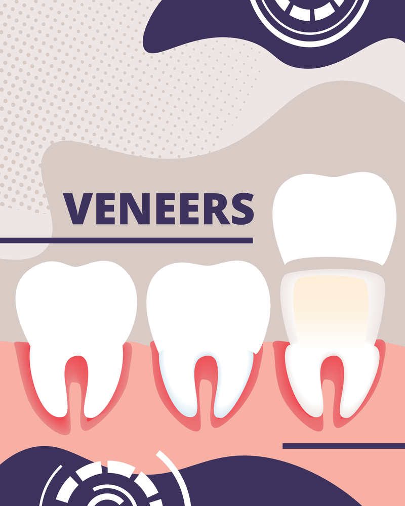 Dental veneers treatment in Denver