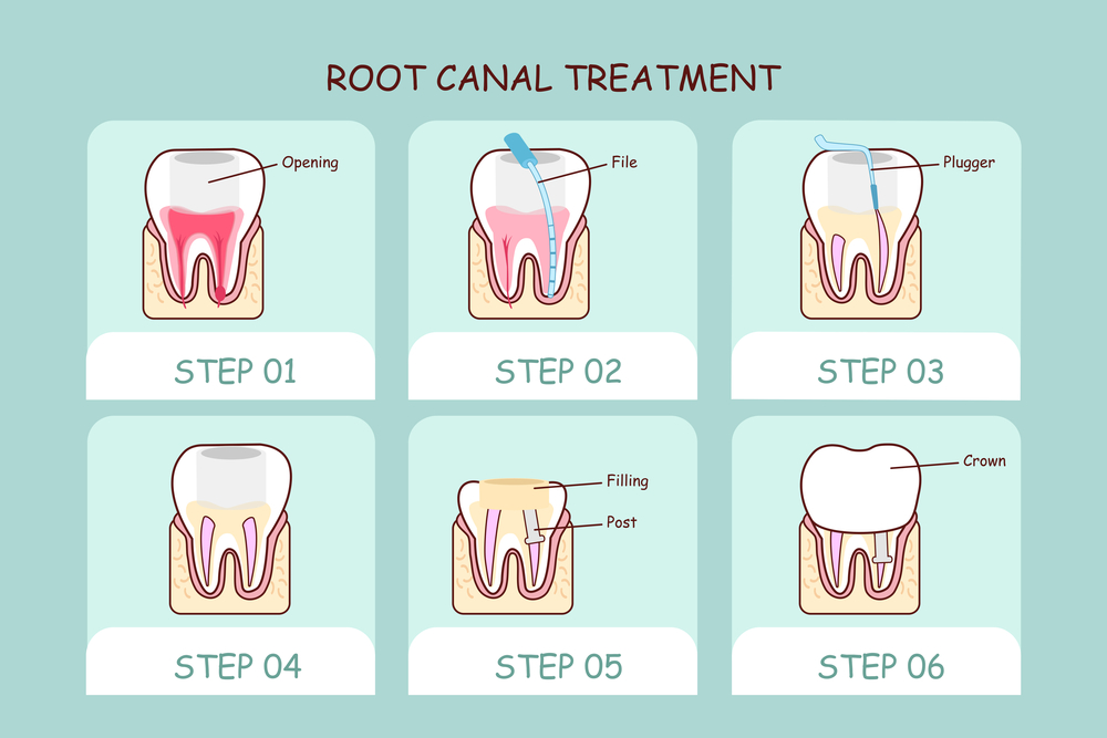 Root Canal Treatment Infographic