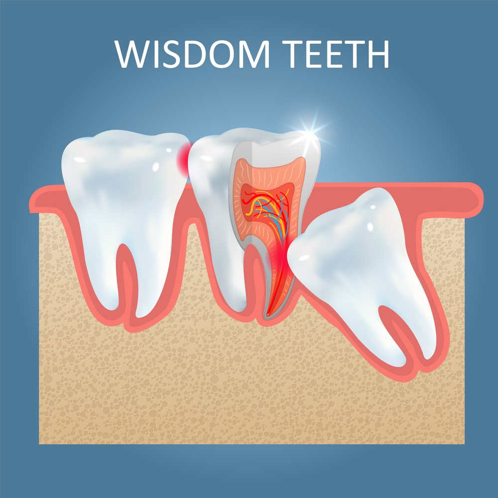 wisdom tooth inforgraphic