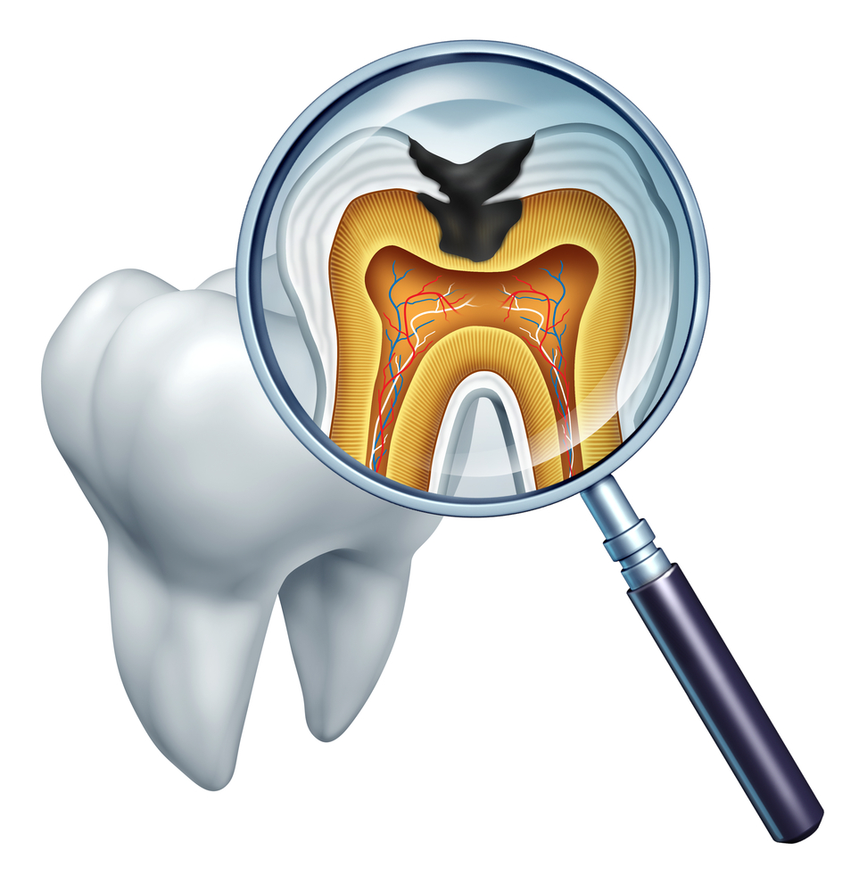 Tooth cavity close up illustration