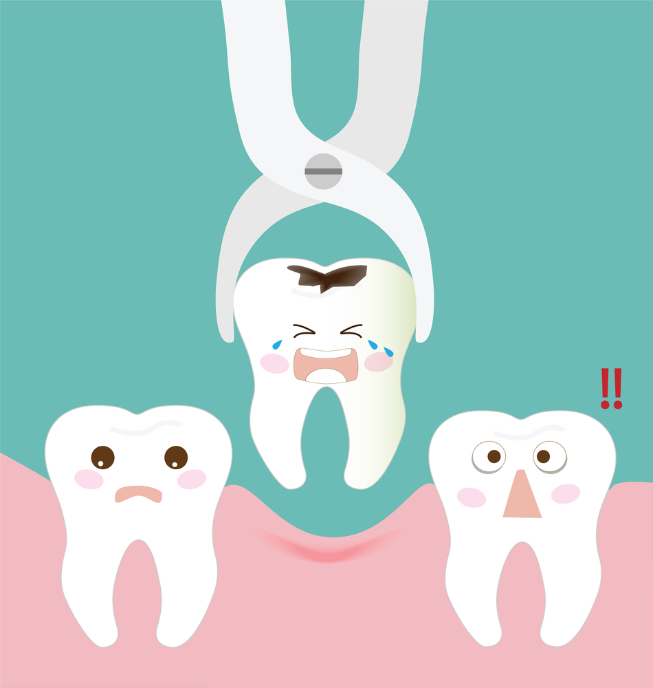 Tooth extraction procedure illustration
